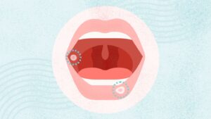 what-are-mouth-lesions-1440x810